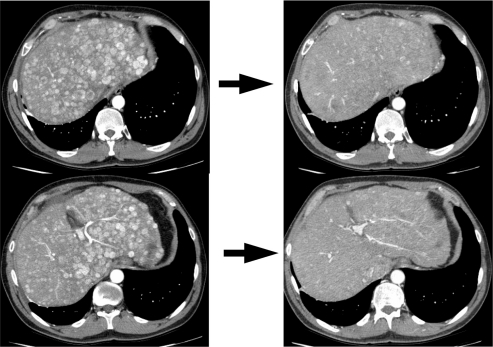 Figure 1 Response to bevacizumab, capecitabine, and oxaliplatin.On left are two cuts demonstrating the characteristic appearance of enhancing liver lesions (note that aorta is bright white signifying arterial phase scan) in a patient with a pancreatic neuroendocrine tumor. On right are corresponding cuts after 2 cycles (6 weeks) of bevacizumab, capecitabine, and oxaliplatin demonstrating marked decrease in vascularity of lesions.