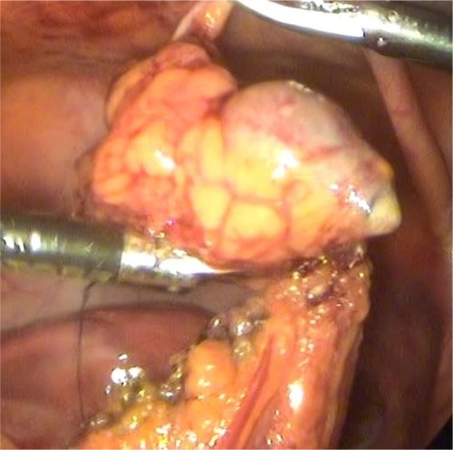 Figure 5 Bipolar electroresection of the part of the omentum with the ingrown IUD.