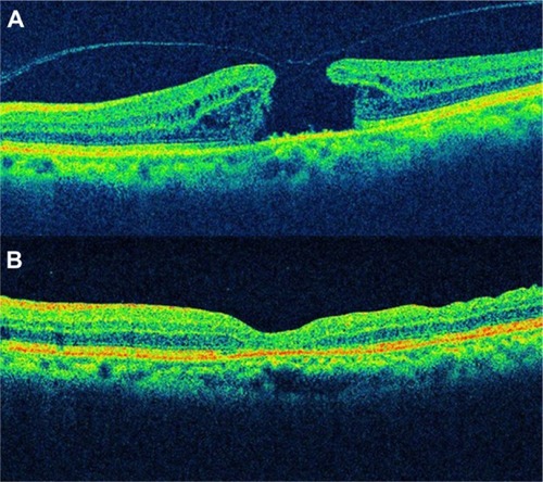 Figure 10 Spectral domain optical coherence tomographic images of a 68-year-old patient with a full-thickness macular hole.