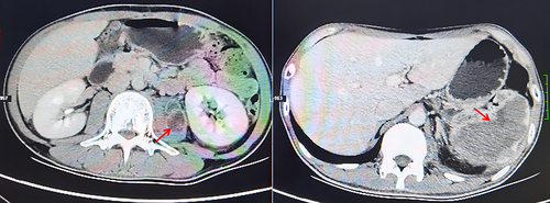 Figure 1 CT plain scan of the patient’s abdomen. The red arrow indicates the low-density region, considering possible abscess (left, left psoas major; right, spleen).