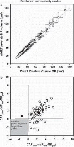 Figure 3. Plot of prostate volumes outlined on pre-radiotherapy and mid-radiotherapy MR scans. Black dots represent the three patients in whom a potential partial migration was estimated comparing sagittal MR images from the two MR scans. Other patients are represented by a white dot. a) Mid-treatment MR prostate volume (MRmid) plotted against the prostate pre-treatment volume outlined on MR (MRpre). Data are from the 90 patients in whom volumes were available in both MR scans. Error bars represents change in volume if the radius of the prostate is changed plus or minus one millimetre. b) Mismatch in MR volumes in co-registered MR volumes were defined as MRpre-MRmid and MRmid - MRpre. A corresponding theoretical difference (CAP2mm) was calculated assuming that the prostate is a sphere and the stent has partial migrated 2 mm between MR scans. Difference between the CAP2mm volume and the two mismatch volumes are plotted in Any true migration of equal to or more than 2 mm should give a dot in the grey area.