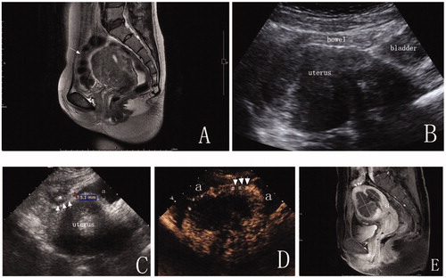 Figure 2. A 43-year-old woman with diffuse adenomyosis. (A) T2WI before MWA. The anterior uterine wall was extensively involved with adenomyosis. A bowel loop was close to the anterior uterine wall. (arrow = bowel). (B) A percutaneous approach was difficult due to bowel interference under ultrasound guidance. (C) After anechoic artificial ascites fluid was added, part of the uterus was separated from the bowel, and a distinct adhesion (arrow) was observed between the uterus and the adjacent bowel (*). (D) A CEUS image displays the ablative margin. The ablative margin (#) is more than 0.5 cm from the serosa where the uterus was not separated from the adjacent structures due to distinct pelvic adhesion (arrow). The ablative margin (*) was 0.3 cm from the uterine serosa where the uterus was completely separated from the adjacent organs by artificial ascites (a). (E) Enhanced T1WI at five days after MWA. The dark shadow indicates the area of lesion ablation (nonperfused volume, NPV). The percentage of NPV in this patient was 72%. The ablative margin was 0.7 cm from the distinct adhesion between the uterus and the bowel (arrow = distinct adhesion between uterus and bowel; a = uterine endometrium).