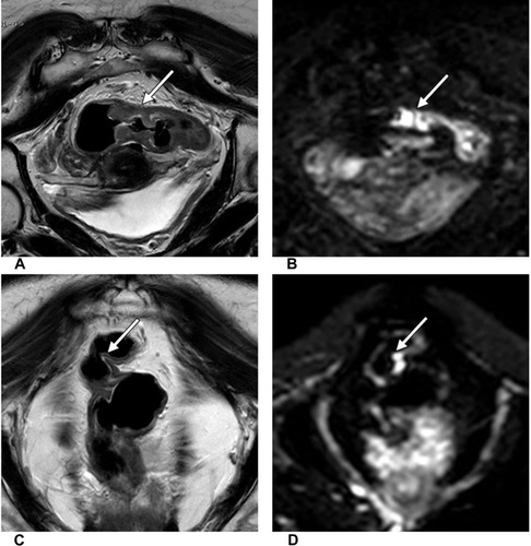 Figure 2 A 62-year-old woman with LARC. The oblique coronal T2WI (A) and DWI (b=1000 s/mm2) (B) show primary rectal cancer before therapy (white arrow). Six weeks after the end of NAT, uneven thickening of the intestinal wall was still shown with intermediate signal intensity in oblique coronal T2WI (C) and hyperintensity signal intensity in DWI (b=1000 s/mm2) (D), which mimic residual tumor (white arrow). Six days later, the patient underwent total mesorectal excision (TME), and the surgical resection specimen achieved pCR.