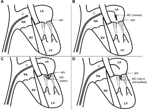 Figure 2 Schematic of MitraClip device insertion.