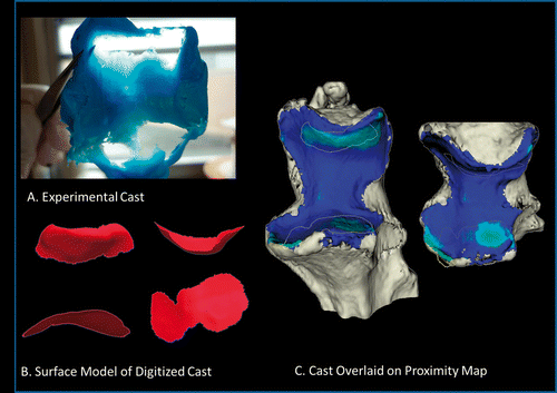 Figure 8. Comparison of experimental cast and proximity map. (A) Experimental cast. (B) The vacant regions of the cast, corresponding to regions of joint contact, were digitized using a tracked stylus. A surface model was created from this point cloud. An edge extraction filter was used to obtain the perimeter of this digitized surface. (C) The digitized cast is overlaid onto a proximity map showing the surface area on the ulna. The threshold used to generate this map is 2.87 mm, as measured from the pre-operative CT. There is 17.35% difference between the experimental cast digitization and the surface area obtained from the computational method.