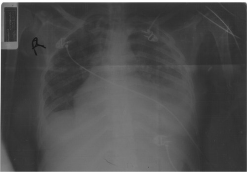 Figure 1 Anterior-posterior supine chest film.