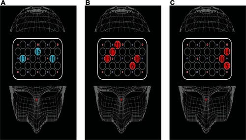 Figure 5 Cortical distribution of significant correlations between activation and performance. (A) In TMT-A, oxy-Hb changes at three channels showed a significant correlation with performance in patients, but not in controls. (B) In TMT-B, oxy-Hb changes at five channels showed a significant correlation with performance in controls, but not in patients. (C) In B–A activation, the values at three channels showed a significant correlation with performance in controls, but not in patients.