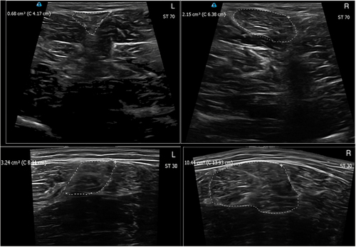 Figure 3. Ultrasound images of a participant from the ACLR group showing the injured (L) and sound (R) limb, with outline tracings of the semitendinosus (ST) for the distal (70; above) and proximal (30; below) sites.