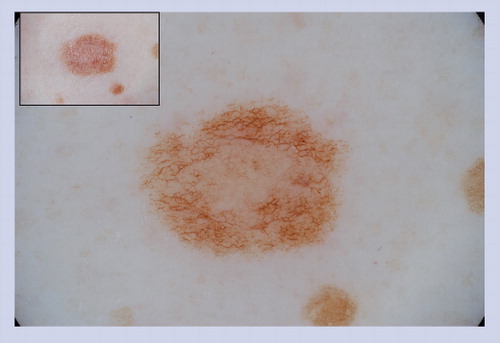 Figure 8. Acquired melanocytic nevus showing a peripheral network with central hypopigmentation.
