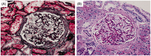 Figure 1. Glomerulus image showing focal segmental sclerosis. (A) Periodic acid silver methenamine stain, ×400; (B) Periodic acid-Schiff stain, ×400.