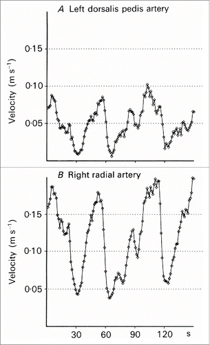Figure 6. Simultaneous measurements from the left dorsalis pedis artery (A) and in the right radial artery (B) (From Lossius, Eriksen and WalløeCitation20) © The Physiological Society. Reproduced by permission of The Physiological Society. Permission to reuse must be obtained from the rightsholder.