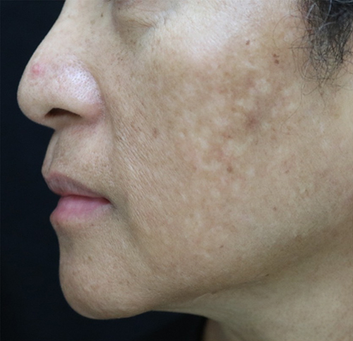 Figure 3 Melasma in patient with Fitzpatrick skin type III with guttate hypopigmentation after multiple sessions of low fluence Q-switch neodymium-doped yttrium aluminum garnet (1064 nm).