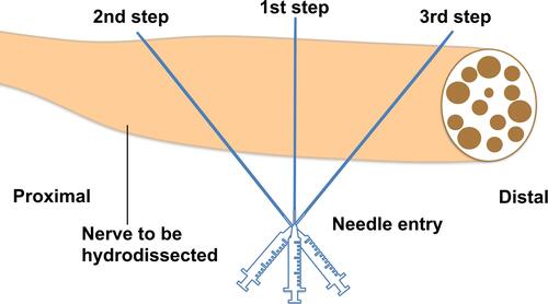 Figure 9 Sequence of hydrodissection (HD) of the diseased nerve using method 1. First, HD is initiated from the site where the nerve is most severely damaged or trapped, thereafter, using the same needle entry point, pivot the probe and the needle to the more proximal and/or distal part of the nerve and repeat the HD.