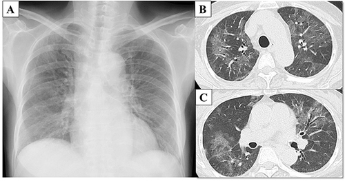 Figure 1 Chest X-ray image showing a bilateral diffuse symmetric reticular interstitial shadow (A). A chest computed tomography scan showing bilateral asymmetric patchy mosaic appearance and ground-glass opacities in the lung subpleural peripheral regions (B and C).