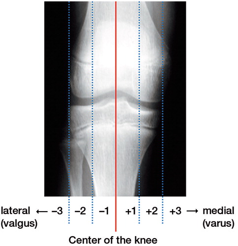 Figure 1. Zones of the mechanical axis according to Stevens. Zone 1 includes the middle 2 quadrants (medial: +1; lateral: –1), zones –2 and –3 are the more lateral (valgus) zones, and zones +2 and +3 are the more medial (varus) zones.