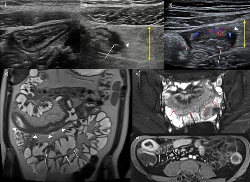 Figure 1. Cross-sectional imaging signs of active disease. i) Conventional B-mode ultrasound of the terminal ileum, including normal mural thickness (≤3 mm), mural stratification and mesentery. ii) Active disease on IUS showing disruption of mural stratification, particularly at the mesenteric border which is blurred (arrowhead). There is bowel wall thickening, including of the submucosa where there is patchy hypoechogenicity. There is also mesenteric inflammation, represented by marked mesenteric expansion (double headed arrow). Linear mural defects with gas are in keeping with deep ulceration (arrow), a sign of more severe inflammation. iii) Intestinal ultrasound image showing hypervascularity of the terminal ileum manifest as increased color Doppler signal. Note the other signs of active disease; bowel wall thickening, edema (with patchy changes in the submucosa, in contrast to i) where it is uniformly echogenic), deep ulceration (arrow), blurring of the bowel mesenteric border (arrowhead) and mesenteric expansion (double headed arrow). iv) Coronal T2-weighted MRE image showing a long segment of severely active disease involving the distal jejunum and proximal ileum (arrowheads). There is bowel wall thickening and edema, in addition to perimural free fluid, also collecting in the right iliac fossa (asterisk). Additionally, there is chronic disease of the more distal ileum (arrows) which appears damaged with multiple pseudosacculations and likely fibrotic predominant strictures. v) Axial fat-saturated T2-weighted imaging better depicts mural and perimural edema. There is severe active disease in a loop of terminal and distal ileum (arrows) with high T2 signal in part reflecting marked mural and perimural edema, including linear high signal extending into the mesentery. vi) Axial post-contrast image showing mural hyperenhancement, particularly mucosal, and engorgement of the vasa recta supplying the inflamed terminal ileal loop (arrows); the comb sign.