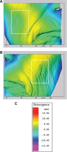 Figure 4 Images from three-dimensional topographies of subject number 1 (female) who had spent more than half of her life working as a medical saleswoman, driving a car 2–5 hours per day. The regions of interest selected for relief analyses (roughness and volume) are represented in the white frames. A) Nonwindow-exposed side (right side). B) Window-exposed side (left side), where the wrinkles are more numerous and deeper. C) Color scale.
