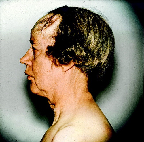 Figure 5.  The patient in Figure 3, 19 months after thyroidectomy, 131I treatment, external radiotherapy and thyroid hormone substitution.