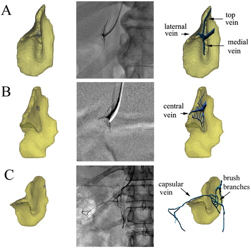 Figure 3. Effect of fusion of the adrenal venographic image and the 3D model. (A) An anteroposterior fusion image of a 50-year-old male patient. The right central vein was in the axial direction, and its image was a point at the catheter tip. The venographic image conformed to the ‘starburst type‘. Veins in the ‘starburst type’ were distributed in the upper part of the 3D model, while the uvula veins in the lower part of the 3D model were not shown. (B) An anteroposterior fusion image of a 34-year-old male patient. The right central vein was in the oblique axial direction and gradually shown, forming a ‘solid triangle type’ with its branches. The three limb veins were distributed in three limbs, referring to the central vein as the centre. No visible veins were shown in the uvula. (C) An anteroposterior fusion image of a 52-year-old female patient. The right central vein was further shown and communicated with renal capsular veins, forming a ‘hollow triangle type‘. The brush vein shown could be a signature vein of adrenal veins. No visible veins were shown in the uvula.