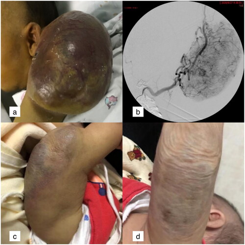 Figure 1. The mass on the infant’s left upper limb was found immediately after birth.a: Lesions located on the left upper limb in a 24-day-old boy, with the surface swollen and purple. b: The angiography of the left brachial artery showed that the feeding arteries of the lesion came from multiple brachial artery branches. c: The swelling was alleviated, tumour size was reduced and skin colour got recovered 1 month after TACE. d: The tumour was completely absorbed and the surface skin was flabby 6 months after TACE.