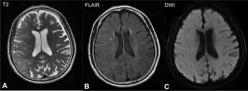 Figure 3 Brain magnetic resonance imaging (MRI) 2 hours after surgery showed hyperintense areas in the right cortex in (A) T2-weighted image and (B) fluid-attenuated inversion recovery (FLAIR) images, and no clear signs of subarachnoid hemorrhage were observed on (C) diffusion-weighted imaging (DWI).