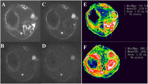 Figure 9. (A–D) are DWI images of the same layer of rabbit VX2 liver tumor when b value is 100, 600, 1000 and 1500 s/mm2, respectively. When b = 100 s/mm2, the normal liver parenchyma and tumor nodules were clearly distinguishable (A). With the increase of b value, contrast between tumor nodules and surrounding structures was obvious, but the image quality decreased, the background noise increased, and the image signal-to-noise ratio decreased (D); (E and F) are pseudo-color ADC images of experimental rabbits in MVLs group before and after the intervention, when b value was 1000 s/mm2, respectively, and the ADC value of tumors increased after the operation.