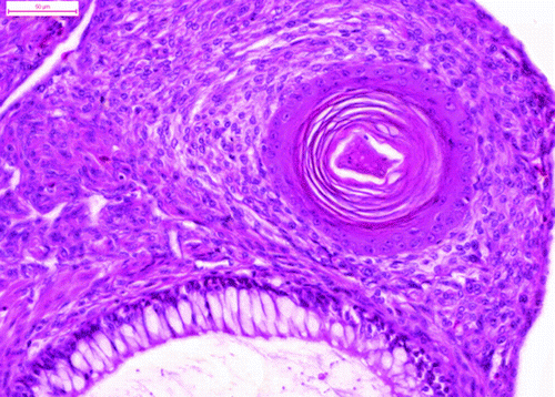 Figure 5.  The stratified squamous epithelium formed a horny pearl (haematoxylin and eosin). Bar =50 μm.