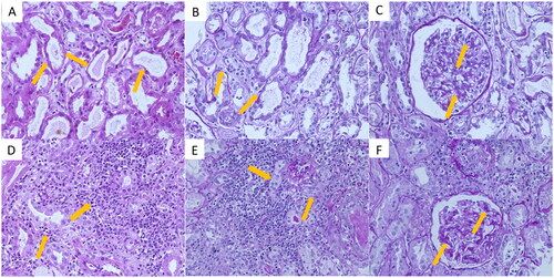 Figure 4. Pathological results of renal biopsy from two cases with AKI. (A–C) Renal tissue specimens from case 1, show the main lesion was acute tubulointerstitial injury; (D–F) from case 2, show acute interstitial nephritis as the main lesion. A: Hematoxylin and eosin (HE) stain shows the brush border of the renal tubules epithelial cells was desquamated, a few red cell casts were seen in the lumen (arrows, 10 × 40); B: Periodic acid-Schiff (PAS) stain shows a small amount of inflammatory cell infiltration in the renal interstitium (arrows, 10 × 40); C: PAS stain shows mild glomerular mesangial cell proliferation with increased mesangial matrix, and segmental endothelial cell swelling and proliferation (arrows, 10 × 40); D: HE stain shows renal interstitial inflammatory cell infiltration, including monocytes, lymphocytes, plasma cells, eosinophils, and neutrophils (arrows, 10 × 40). E: PAS stain shows that the renal tubules are extruded, the basement membrane is thickened, and the epithelial cells are swollen (arrows, 10 × 40); F: PAS stain shows mild glomerular mesangial cell proliferation and mesangial matrix increasing (arrows, 10 × 40).