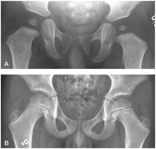 Figure 3. A. A boy with mottled appearance of the left ossific nucleus (grade-1 AVN) at 12-month follow-up. Treatment had been initiated at 2 days of age for left-sided dislocation (Barlow-positive). B. Normal appearance of the femoral head at 8 years.