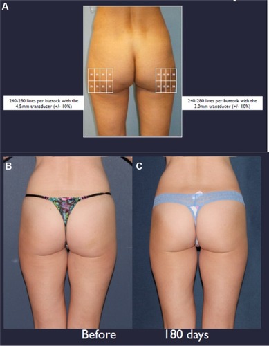 Figure 2 (A) Ultherapy® buttock treatment map. (B) Before treatment. (C) 180 days post-treatment (Courtesy of Dr Sabrina Fabi).