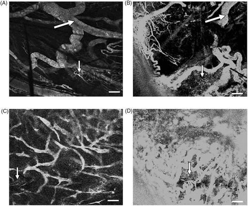 Figure 6. Representative confocal micrographs of the tumors in the mechanistic study. (A, C) Images of control tumors of mice treated with 30 and 150 pulses per site, respectively. (B, D) Images of tumors treated with 30 and 150 pulses per site, respectively. All other high intensity focused ultrasound parameters were constant: frequency, 1.0 MHz; pulse repetition frequency, 0.5 Hz; spatial average–time average intensity, 1376 W/cm2; and time, 2 min per site. Increased extravasation is evident in tumors that were exposed to high-intensity focused ultrasound. Relative increase in extravasation is also evident in D, where 150 pulses per site were given, as opposed to B, which received 30 pulses per site. Permeability appears to be isolated to capillary beds and not related to larger vessels. Large arrows = blood vessels, small arrows = postcapillary venules, bar = 80 µm. (Citation[62] Reprinted with permission.)