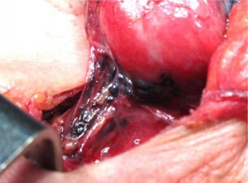 Figure 2 Intraoperative view of the black-stained clusters of lymph nodes by CN injection.