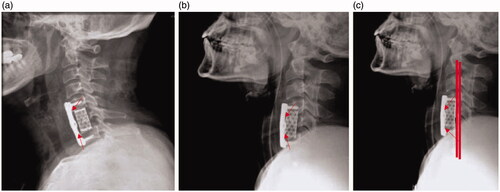 Figure 4. (a) Postoperative lateral radiograph image, (b) lateral radiograph image after one year and (c) lateral radiograph image after 2 years.