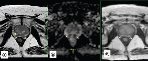 Figure 2. Multiparametric prostatic MRI after intravesical bacillus Calmette–Guérin therapy.(A) Axial T2-weighted image: a focal and ill-defined hypointense lesion in the right and left PZ (arrow) exhibits a bulging contour (arrowhead), suspicious of prostate cancer. (B) Apparent diffusion coefficient map: the PZ lesions (arrows) exhibit very low signal intensity in the apparent diffusion coefficient map. This is compatible with significant diffusion restriction in those areas. (C) Dynamic contrast enhancement shows moderate to significant early and diffuse enhancement mainly in the PZ. These findings are compatible with a PI-RADS score of 5.PZ: Peripheral zone.