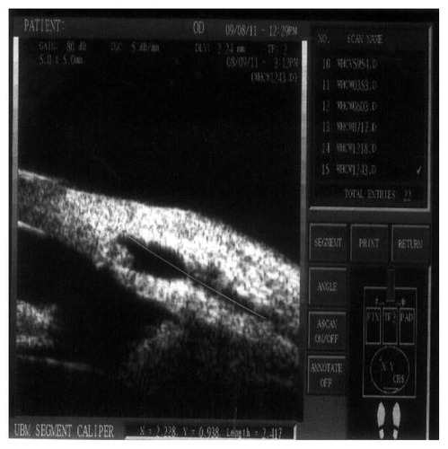 Figure 11 The measurement of the bleb breadth.