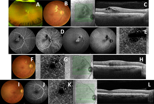Figure 3 Case Report 3: At presentation: (A and B) Retinitis in the upper nasal macular region with intraretinal hemorrhages in retinography; (C) Macular SD-OCT showed macular edema; (D) – AF and ICGA showed an area of contrast diffusion in the superior temporal periarch (time: 1.04.26 and 6.48.54); (E) OCT-A showed area of non-perfusion in the upper nasal macula. At 1st month of symptoms: (F) Retinography with whitish lesion in the upper nasal macula; (G) OCT-A showed area of non-perfusion area in the upper nasal macula; (H) Macular SD-OCT showed macular edema. At 6th month of symptoms: (I) Retinography without hemorrhages or visible area of retinitis: (J and K) Area of vascular reperfusion without contrast diffusion on AF and ICGA (time: 0.27.87) and OCT-A; (L) No macular edema on Macular SD-OCT.