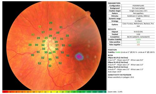 Figure 2 Example of a print-out from the circumpapillary microperimetric assessment (MP-3 microperimeter, Nidek®).