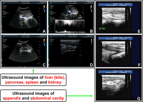 Figure 5 Abdominal color Doppler ultrasonography showed normal transplanted liver, bile, and renal function (at 1298 days of life), and no lump, seroperitoneum, and abnormal flow in the abdominal cavity and/or around the appendix (at 1383 days of life) (words in red for emphasis). (A and B) The transplanted liver was regular in shape, smooth in surface, homogeneous in parenchymal echo and even in light spot. The portal vein blood flow velocity at the portal was 51 cm/s. The inner diameter of the inferior vena cava was not wide and the inner diameter of the common bile duct was not expanded. (C and D) Both kidneys were normal in shape and size, with a clear outline, complete and smooth renal capsule, uniform echo in parenchyma, and concentrated echo in the collecting system. No obvious abnormal echo was observed. (E–G) Abdominal color Doppler ultrasound revealed no lump, seroperitoneum, and abnormal flow in the abdominal cavity and/or around the appendix.