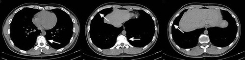 Figure 3. Picture of CT scan from return visit. All the original bone damages recovered (shown by arrows).