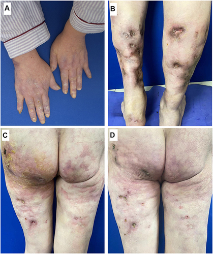 Figure 3 Pictures of hands (A), calves (B) and the new rash of the left hip (C) at discharge indicated skin lesions were improved as compared with admission; (D) picture of the new rash at re-examination indicated further improvement.