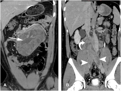 Figure 8 Retroperitoneal metastasis teratoma. (A) Large heterogeneous retroperitoneal mass lesion with internal necrotic and cystic contents. (B) Retroperitoneal spread with vascular invasion involving iliac veins and IVC.