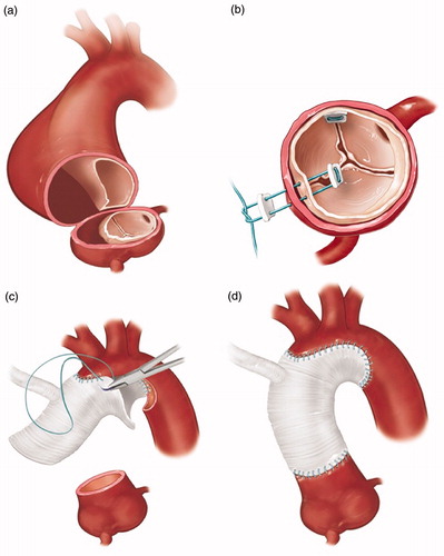 Figure 4. Key steps in surgical repair of ATAAD. (a) Resection of the ascending aorta starting proximally at the sinotubular junction. (b) Resuspension of the aortic valve commisures to treat or prevent aortic regurgitation. (c) Open distal anastomosis with hemiarch replacement (with perfusion cannulae omitted for clarity). (d) Completed repair; perfusion through integrated graft side-arm. Drawings: Hjördís Bjartmarz. Copyritght: ©Tomas Gudbjartsson.