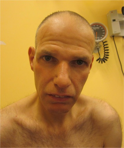 Figure 1 Clinical photograph of the present patient showing mild facial dysmorphic features, including deeply set eyes and a prominent nose with high nasal bridge, possibly fitting within the spectrum of facial dysmorphic features in BRPS.