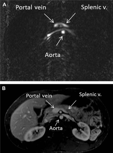 Figure 5 (A) Phase contrast (nongadolinium) magnetic resonance axial images of the abdomen below the level of the celiac artery. The splenic vein (v.) and portal confluence are identified. The bright signal shows normal directional flow of the splenic vein. (B) Post-gadolinium magnetic resonance axial images of the abdomen below the level of the celiac artery. The splenic vein and portal confluence are identified. This corresponds to the anatomy seen in (A).