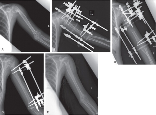 Figure 2. A. Case no 20. A 10-year-old female with shortened and deformed (varus angulation) proximal humerus due to osteomyelitis.B. Bifocal humeral osteotomy with use of hybrid monolateral fixator for correction of deformity and lengthening simultaneously.C. Desired lengthening of the humerus at the distal osteotomy site.D. Full consolidation of the lengthening site, 7 months after osteotomy. Proximal pins and assembly were removed after healing of proximal osteotomy, thereby converting it to a simple monolateral fixator.E. Final follow-up 5 years after osteotomy, showing excellent remodeling.