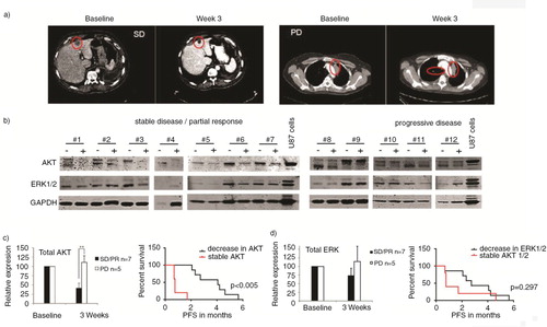 Fig. 6.  Representative CT images of patient #7 at baseline and with stable disease (SD) at 3 weeks on sorafenib/metformin and of patient #9 at baseline and with progressive disease (PD) at 3 weeks on sorafenib/metformin. (a) Western blot analysis was performed of plasma EVs of NSCLC patients (n=12). (b) Total AKT and ERK1/2 levels in EVs, 3 weeks after start of treatment, are shown. Patients with PD and SD or partial response (PR) on sorafenib/metformin treatment are grouped. (b) Samples are paired pre- and on-treatment samples depicted with – and +, respectively. Signal intensities were quantified by Image J imaging analysis software. (c) Kaplan Meier curves were generated for the treatment response (PFS) of patients with stable and decreased AKT and ERK1/2 levels in EVs. (c–d) To assess statistical significance, the 2-tailed unpaired t-test was applied. *p<0.001, **p<0.0001. The log-rank test was used for statistical analysis of survival analyses.