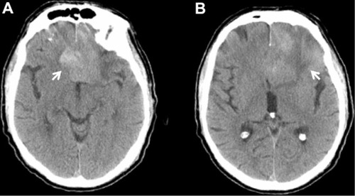 Figure 1 Axial CT demonstrates midline hyperdensity (arrow; A), and left frontal surrounding hypodensity (arrow; B).