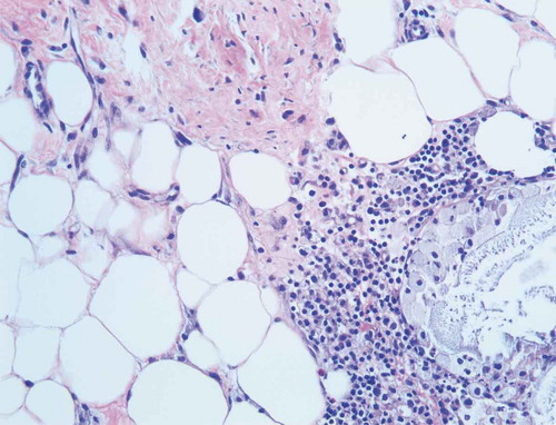 Picture 7. Areas of associated fat necrosis