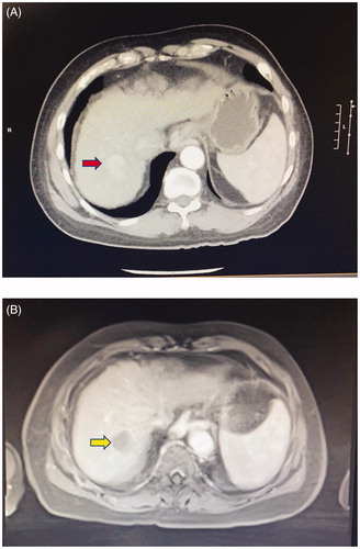 Figure 5. A 66-year-old man with cirrhosis and HCC in segment 7 of the liver. (A) Contrast CT scan showing the hypervascular tumor (red arrow). The patient subsequently underwent HIFU ablation of the tumor, facilitated by artificial right pleural effusion. (B) Contrast MRI taken 1 month after treatment shows no arterial enhancement in the tumor (yellow arrow), which is in keeping with good treatment response.