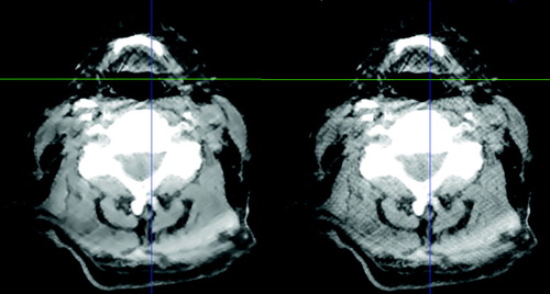 Figure 2.  The effect of applying the GREYCstoration filter to a head and neck CBCT image. The unfiltered image is the one on the right. The level of noise has been reduced without blurring the image. Window-level settings have been set to emphasize the difference between the two images.